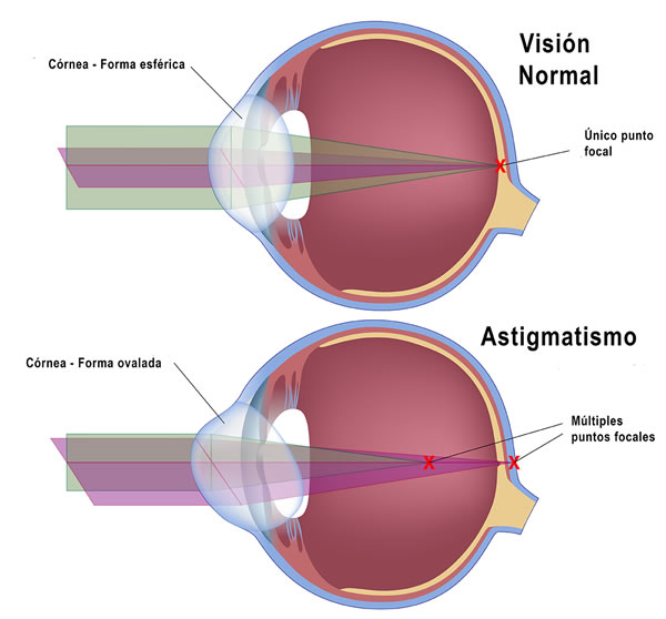 astigmatismo