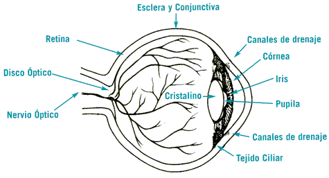 glaucoma