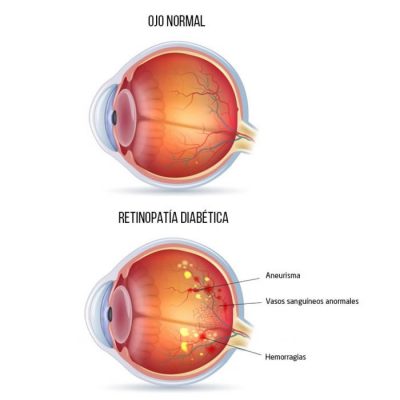 retinopatía diabética